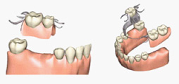 局部床義歯の写真