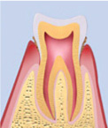 初期歯周病（歯肉炎）の画像
