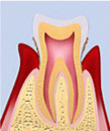 中度歯周病（歯周病）の画像