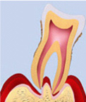 重度歯周病（歯周病）の画像